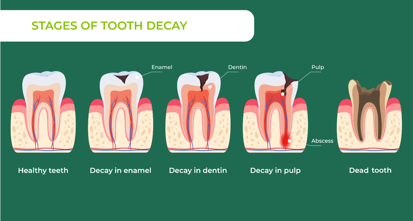 Tooth decay graphic