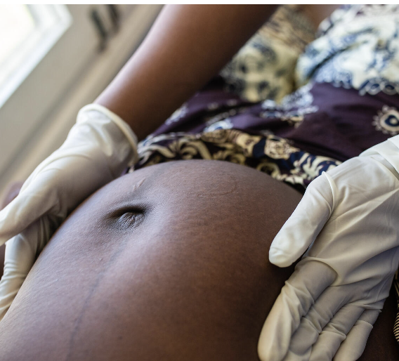 OB Fistula