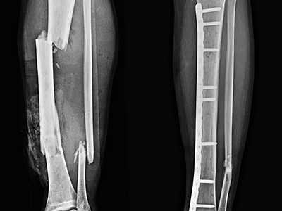 Fracture