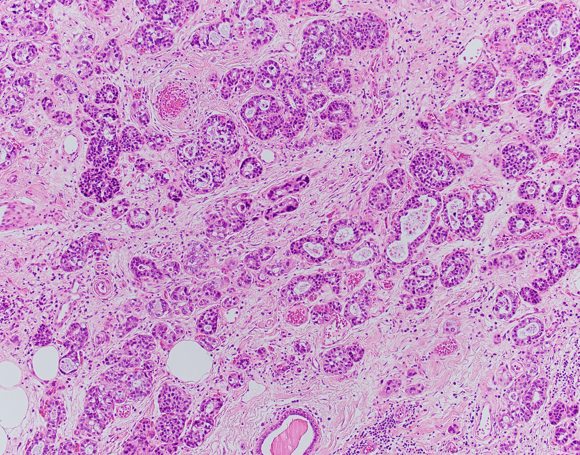 Acinic cell ca 20x