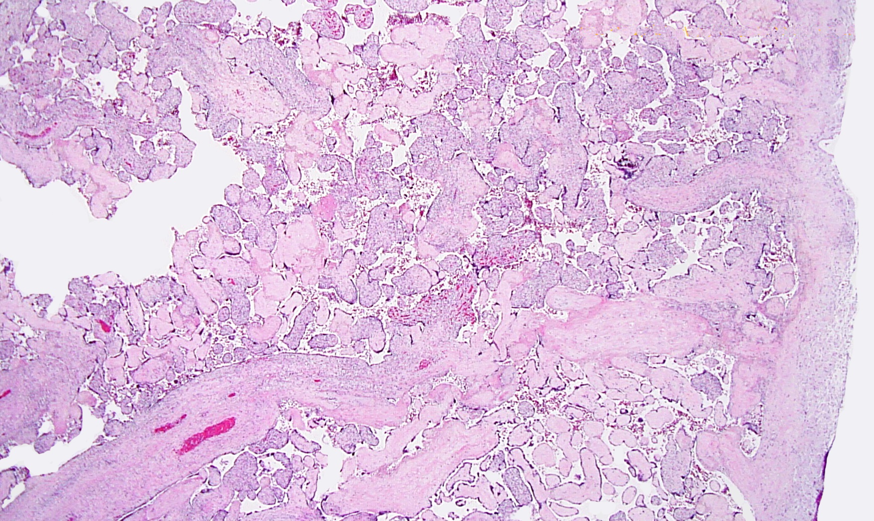 FIG1 DIFFUSE HIGRD VUE w DVSCL BASAL and MIDDL LOPOW 2