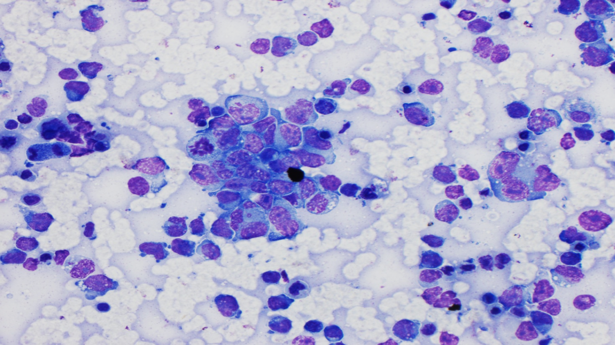 Condyloma Lata spirochete IHC high power1