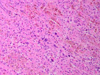 FA_bizarre_nuclei_20x.jpg