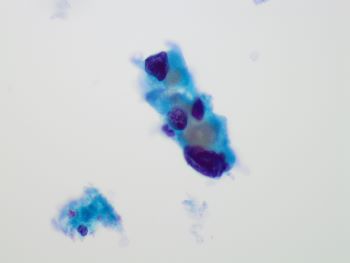 FA_bizarre_nuclei_60x.jpg