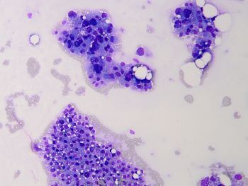 FA_bizarre_nuclei_DQ_20x.jpg