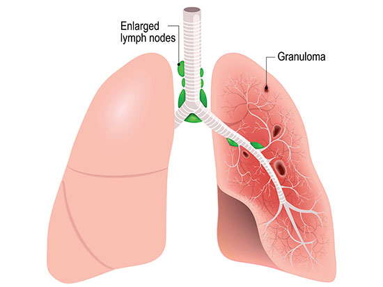 sarcoidosis stream