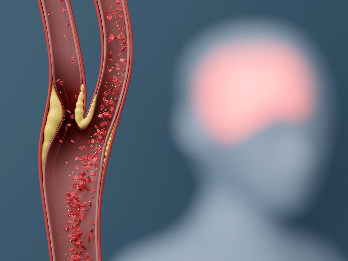 Graphic showing carotid artery with plaque build-up