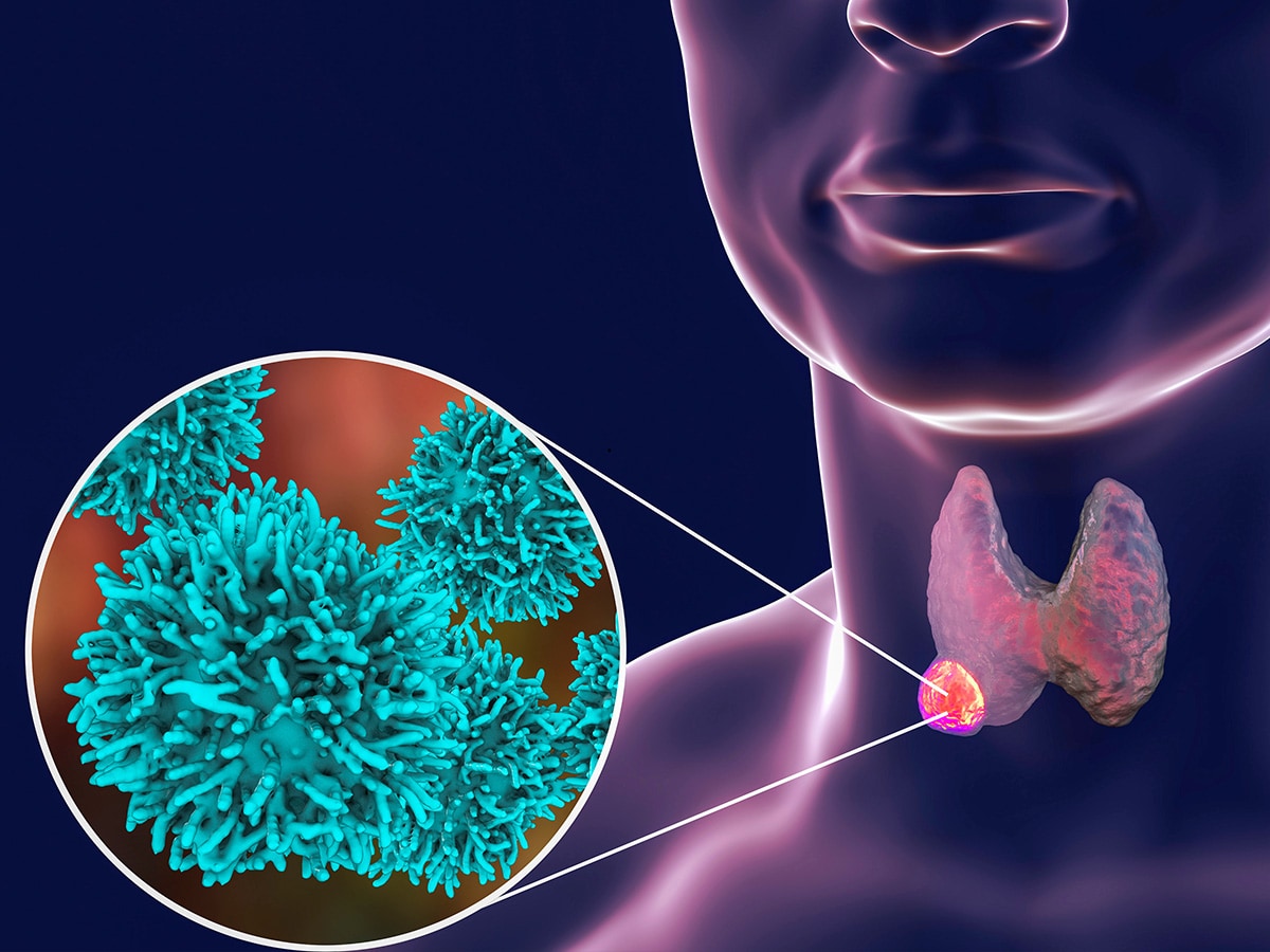 3D illustration showing thyroid gland with tumor inside human body and closeup view of thyroid cancer cells.