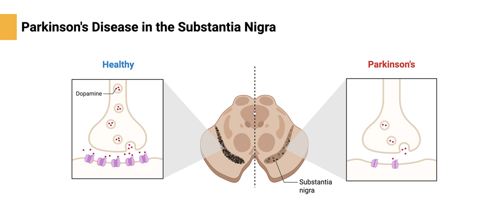 rep parkinsons nigra 1000px